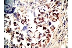 Human lung cancer tissue stained by Rabbit Anti-CRAMP(140-173) (Mouse) Antibody (Cathelicidin antibody  (AA 140-173))