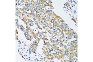 Immunohistochemistry of paraffin-embedded human lung cancer using SLC25A13 antibody (ABIN6292454) at dilution of 1:100 (40x lens). (slc25a13 antibody)