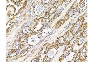 ABIN7096048 and ABIN7100110 at 1/100 staining human ovarian cancer by IHC-P.