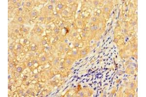 Immunohistochemistry of paraffin-embedded human liver cancer using ABIN7157008 at dilution of 1:100 (Inversin antibody  (AA 1-101))