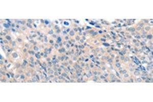 Immunohistochemistry of paraffin-embedded Human cervical cancer tissue using SLC17A6 Polyclonal Antibody at dilution of 1:100(x200) (Solute Carrier Family 17 (Vesicular Glutamate Transporter), Member 6 (SLC17A6) antibody)