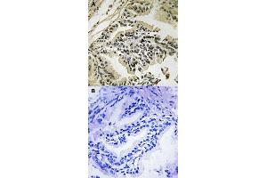 Immunohistochemical staining of human prostate carcinoma tissue by EIF2AK3 (phospho T982) polyclonal antibody  without blocking peptide (A) or preincubated with blocking peptide (B). (PERK antibody  (pThr982))