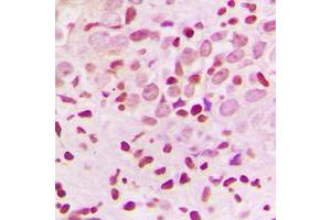 Immunohistochemical analysis of ZNF174 staining in human breast cancer formalin fixed paraffin embedded tissue section. (ZNF174 antibody  (Center))