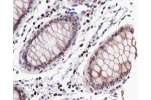 ABIN6267227 at 1/200 staining human colon cancer tissue sections by IHC-P. (IKBKB antibody  (pTyr199))