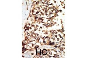 Formalin-fixed and paraffin-embedded human cancer tissue reacted with the primary antibody, which was peroxidase-conjugated to the secondary antibody, followed by DAB staining. (PKD2 antibody  (C-Term))