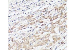 Immunohistochemistry of paraffin-embedded Human liver cancer using IGFBP1 Polyclonal Antibody at dilution of 1:100 (40x lens). (IGFBPI antibody)