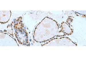 Immunohistochemistry of paraffin-embedded Human thyroid cancer tissue using L3MBTL2 Polyclonal Antibody at dilution of 1:70(x200) (L3MBTL2 antibody)