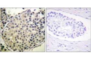 Immunohistochemistry analysis of paraffin-embedded human breast carcinoma, using eIF4G (Phospho-Ser1108) Antibody. (EIF4G1 antibody  (pSer1148))
