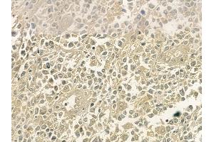 ABIN6254902 and ABIN6267061 at 1/100 staining human non-Hodgkin lymphoma by IHC-P. (NF-kB p65 antibody  (acLys310))