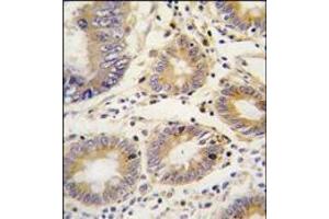 Formalin-fixed and paraffin-embedded human colon carcinoma tissue reacted with LEFTB antibody (C-term), which was peroxidase-conjugated to the secondary antibody, followed by DAB staining. (LEFTY1 antibody  (C-Term))