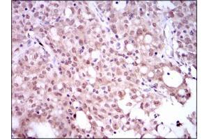 Immunohistochemical analysis of paraffin-embedded cervical cancer tissues using SRY mouse mAb with DAB staining.