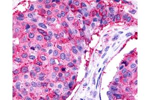 Anti-TPRA1 / GPR175 antibody IHC of human Breast, Carcinoma. (GPR175 antibody  (Cytoplasmic Domain))