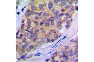 Immunohistochemical analysis of PLA2G4A (pS505) staining in human breast cancer formalin fixed paraffin embedded tissue section. (PLA2G4A antibody  (pSer505))