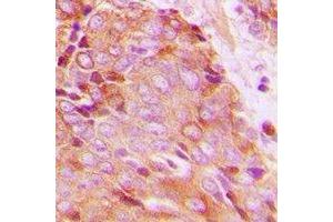 Immunohistochemical analysis of 14-3-3 zeta (pT232) staining in human breast cancer formalin fixed paraffin embedded tissue section. (14-3-3 zeta antibody  (C-Term, pThr232))