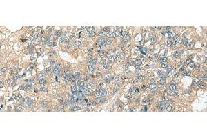 Immunohistochemistry of paraffin-embedded Human gastric cancer tissue using CASR Polyclonal Antibody at dilution of 1:60(x200) (CASR antibody)