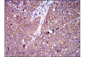 Immunohistochemical analysis of paraffin-embedded bladder cancer tissues using CLGN mouse mAb with DAB staining. (Calmegin antibody  (AA 249-405))