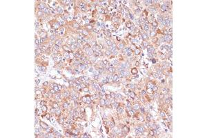 Immunohistochemistry of paraffin-embedded human liver cancer using Y antibody (ABIN6132787, ABIN6150315, ABIN6150320 and ABIN6214108) at dilution of 1:100 (40x lens). (YAP1 antibody  (AA 155-504))