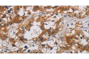 Immunohistochemistry of paraffin-embedded Human thyroid cancer using CNDP1 Polyclonal Antibody at dilution of 1:30 (CNDP1 antibody)
