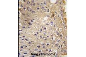 Formalin-fixed and paraffin-embedded human lung carcinoma tissue reacted with G9L1 Antibody  1814i , which was peroxidase-conjugated to the secondary antibody, followed by DAB staining. (ATG9A antibody  (AA 723-753))