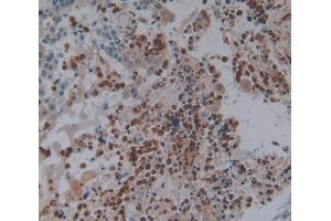 Used in DAB staining on fromalin fixed paraffin- embedded skin cancer tissue (FOS antibody  (AA 55-298))