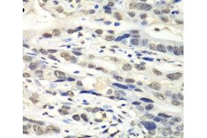Immunohistochemistry of paraffin-embedded Human gastric cancer using NUDT1 Polyclonal Antibody at dilution of 1:100 (40x lens). (NUDT1 antibody)