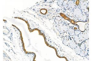 ABIN6260321 and ABIN6277297 at 1/100 staining Human esophageal cancer and adjacent normal tissues by IHC-P. (Betacellulin antibody  (N-Term))