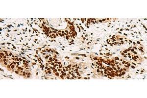 Immunohistochemistry of paraffin-embedded Human esophagus cancer tissue using HNRNPA3 Polyclonal Antibody at dilution of 1:45(x200) (HNRNPA3 antibody)