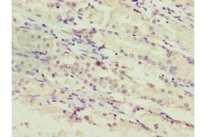 Immunohistochemistry of paraffin-embedded human gastric cancer using ABIN7169284 at dilution of 1:100 (PPP2R3C antibody  (Regulatory Subunit B))