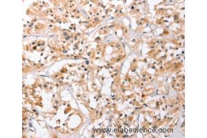 Immunohistochemistry of Human thyroid cancer using HDAC8 Polyclonal Antibody at dilution of 1:40