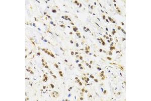 Immunohistochemistry of paraffin-embedded human breast cancer using RAD50 Antibody. (RAD50 antibody)