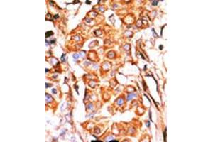 Formalin-fixed and paraffin-embedded human cancer tissue reacted with the primary antibody, which was peroxidase-conjugated to the secondary antibody, followed by AEC staining. (Glycerol Kinase antibody  (C-Term))