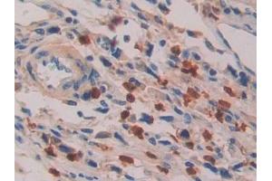 Detection of IL16 in Human Stomach cancer Tissue using Polyclonal Antibody to Interleukin 16 (IL16) (IL16 antibody  (AA 1203-1332))