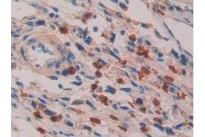 Detection of IL16 in Human Stomach cancer Tissue using Polyclonal Antibody to Interleukin 16 (IL16)