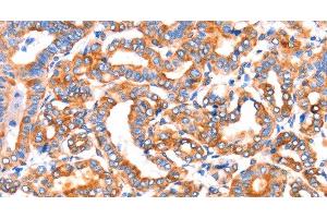 Immunohistochemistry of paraffin-embedded Human thyroid cancer tissue using SEPT4 Polyclonal Antibody at dilution 1:50 (Septin 4 antibody)
