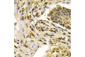 Immunohistochemistry of paraffin-embedded human esophageal cancer using IFIH1 antibody (ABIN5971229) at dilution of 1/200 (40x lens). (IFIH1 antibody)
