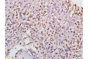 Formalin-fixed and paraffin embedded human gastric carcinoma labeled with Anti-Phospho-PKC gamma (Thr514) Polyclonal Antibody, Unconjugated (ABIN703285) at 1:200 followed by conjugation to the secondary antibody (PKC gamma antibody  (pThr514))