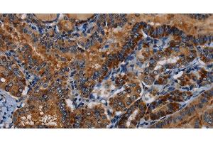 Immunohistochemistry of paraffin-embedded Human thyroid cancer tissue using PIDD1 Polyclonal Antibody at dilution 1:30 (PIDD antibody)
