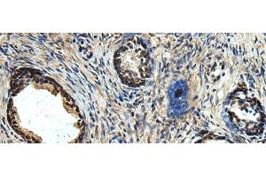 Immunohistochemistry of paraffin-embedded Human prost ate cancer tissue using ERLIN1 Polyclonal Antibody at dilution of 1:50(x200) (ERLIN1 antibody)