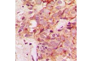Immunohistochemical analysis of IRAK3 staining in human breast cancer formalin fixed paraffin embedded tissue section. (IRAK3 antibody  (C-Term))