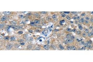 Immunohistochemistry of paraffin-embedded Human breast cancer using PBOV1 Polyclonal Antibody at dilution of 1/20 (PBOV1 antibody)