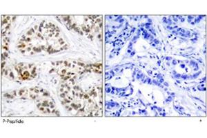 Immunohistochemical analysis of paraffin-embedded human breast carcinoma tissue using RELB (phospho S552) polyclonal antibody .
