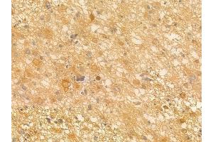 ABIN6263242 and ABIN6266551 at 1/100 staining human astrocytoma by IHC-P.