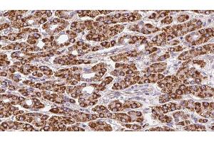 ABIN6272373 at 1/100 staining Human liver cancer tissue by IHC-P. (OR51F2 antibody  (C-Term))