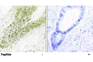 Immunohistochemistry analysis of paraffin-embedded human colon carcinoma tissue, using UBN1 polyclonal antibody . (Ubinuclein 1 antibody)