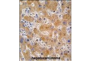 Formalin-fixed and paraffin-embedded human hepatocarcinoma tissue reacted with OA4 antibody (N-term) 7591a , which was peroxidase-conjugated to the secondary antibody, followed by DAB staining. (APOA4 antibody  (N-Term))