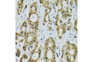Immunohistochemistry of paraffin-embedded human rectal cancer using RPS7 antibody (ABIN5974069) at dilution of 1/100 (40x lens). (RPS7 antibody)
