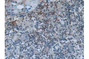 IHC-P analysis of Human Lung Cancer Tissue, with DAB staining. (SCGB1A1 antibody  (AA 23-91))