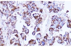 Immunohistochemistry of paraffin-embedded Human liver cancer using SHMT2 Polyclonal Antibody at dilution of 1:100 (40x lens). (SHMT2 antibody)