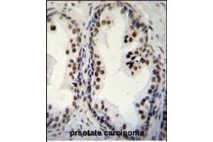 DDX27 Antibody (C-term) (ABIN655057 and ABIN2844686) immunohistochemistry analysis in formalin fixed and paraffin embedded human prsotate carcinoma followed by peroxidase conjugation of the secondary antibody and DAB staining. (DDX27 antibody  (C-Term))