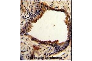 Formalin-fixed and paraffin-embedded human prostate carcinoma with NDRG1 Antibody (N-term), which was peroxidase-conjugated to the secondary antibody, followed by DAB staining. (NDRG1 antibody  (N-Term))